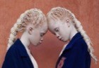 Альбинизм кожи: что такое и как часто встречается?